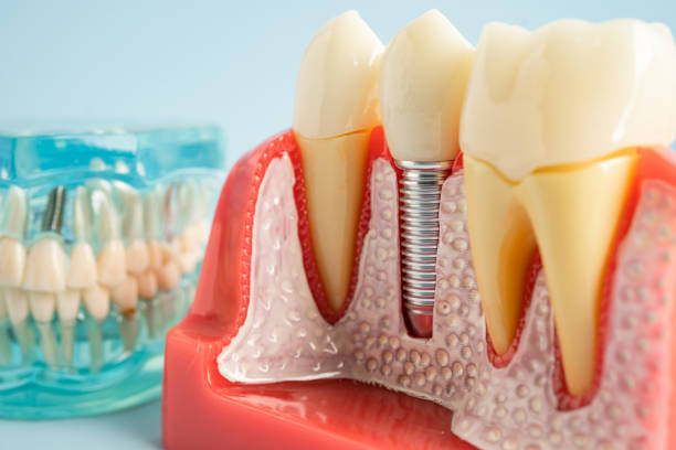 Best Dental Inlays and Onlays  in West Bradenton, FL